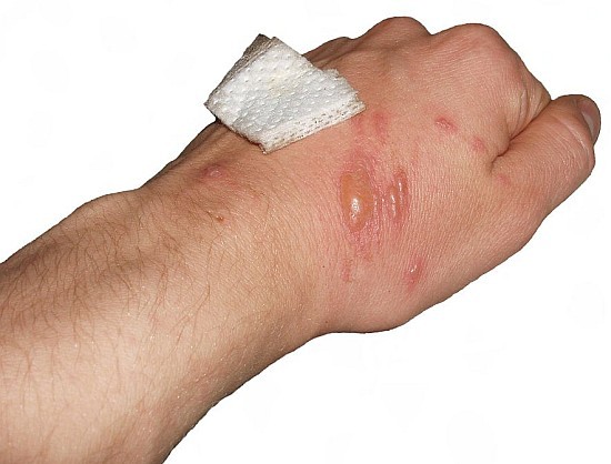 Uszkodzenia skóry po kontakcie z barszczem