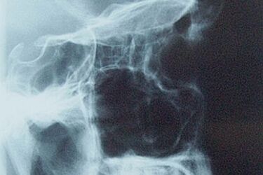Szpital gruźlicy i chorób płuc kupi nowoczesny ambulans RTG
