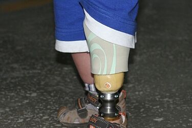 Naukowcy z Wydziału Mechanicznego PB stworzyli protezę na nóżkę dwulatka