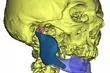 Skomplikowna operacja w białostockim szpitalu. Wszczepiono implant 3D