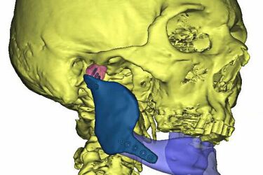 Skomplikowna operacja w białostockim szpitalu. Wszczepiono implant 3D