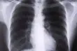 Konsultacje lekarzy i bezpłatne badania spirometryczne