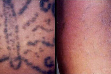 Ile kosztuje usuwanie tatuażu w białostockich gabinetach?