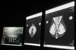 Mammografia nic nie kosztuje, a może uratować życie
