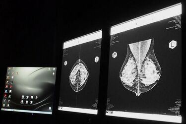 Mammografia nic nie kosztuje, a może uratować życie