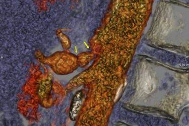 W USK przeprowadzono nowatorską operację. To był 3. taki zabieg w Polsce