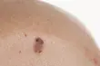 M.in. chorzy na raka skóry będą mogli skorzystać ze specjalnych leków