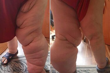 Paweł z Białegostoku ma 30-kilogramowe guzy. Po wycięciu odrastają