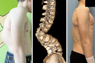 Chirurdzy z UDSK wykonali zabieg rekonstrukcyjny deformacji kręgosłupa u 13-latka