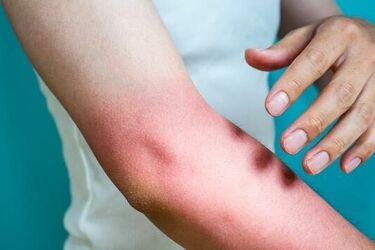 Nigdy nie przykładaj lodu do oparzenia