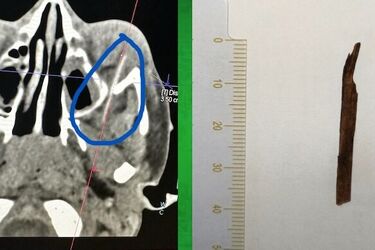 Rodzice przeżyli chwile grozy. Drzazga w oku u 7-latka i kulka z pistoletu u 14-latki
