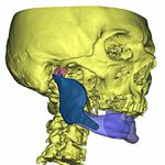 Skomplikowna operacja w białostockim szpitalu. Wszczepiono implant 3D