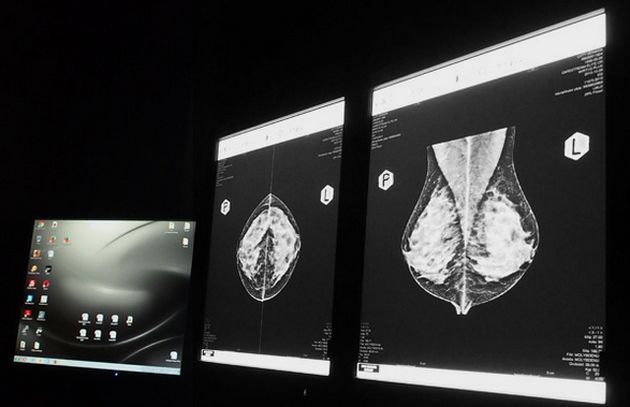 Mammografia nic nie kosztuje, a może uratować życie