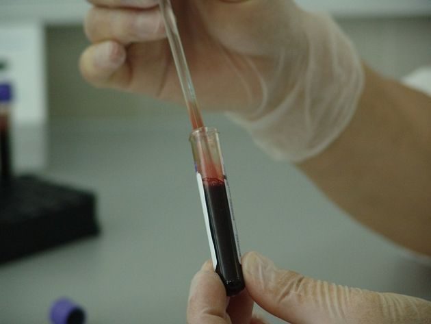 Grupa krwi ma wpływ na ryzyko zakażenie koronawirusem. Tak wynika z badań naukowców