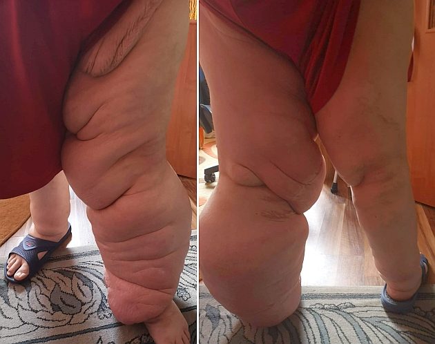 Paweł z Białegostoku ma 30-kilogramowe guzy. Po wycięciu odrastają
