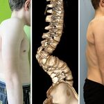 Chirurdzy z UDSK wykonali zabieg rekonstrukcyjny deformacji kręgosłupa u 13-latka