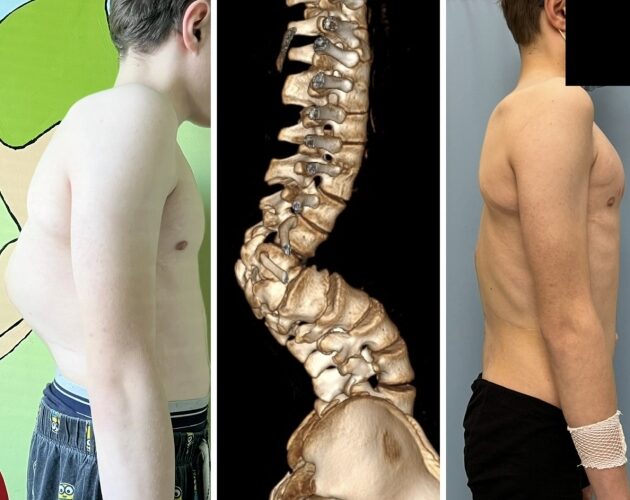 Chirurdzy z UDSK wykonali zabieg rekonstrukcyjny deformacji kręgosłupa u 13-latka