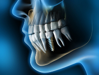Czar-Dent Centrum Implantologii i Stomatologii Estetycznej