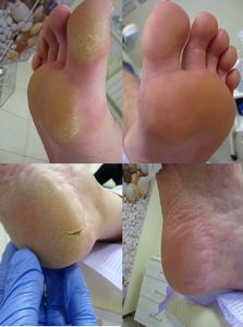 Usuwanie odcisków i modzeli wrastające paznokcie pękające pięty pedicure leczniczy